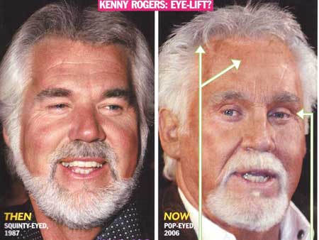 kenny-rogers-face-lift